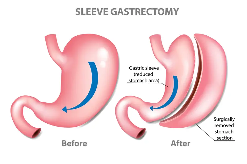 Sleeve-Gastrectomy